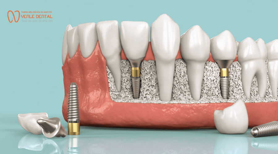 trồng răng Implant là gì